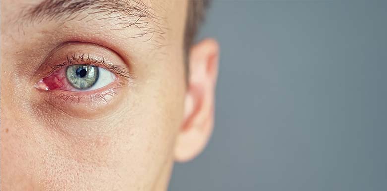 Close-up of a person with a red, irritated eye looking directly at the camera against a plain background.